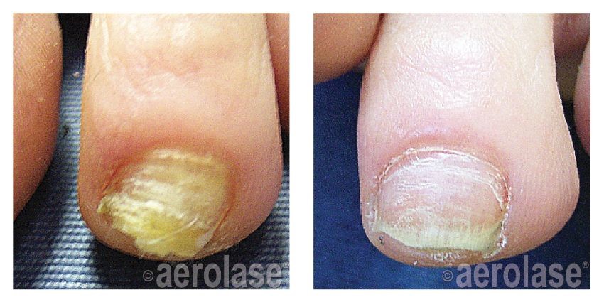 Cosmetic Nail Treatment Florence SC