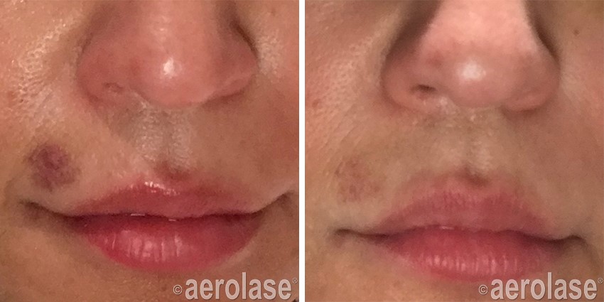 Treatment of Post Filler Injection Bruises Florence SC