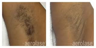 Laser Hair Removal Florence SC