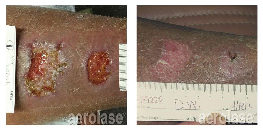 Skin Injury Treatment Florence SC