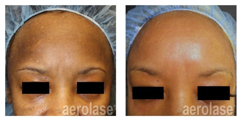 Melasma Treatment Florence SC
