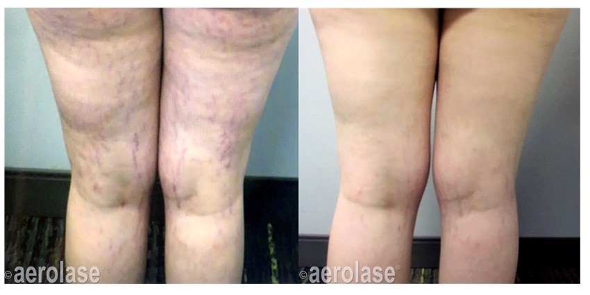 Spider Veins Treatment Florence SC