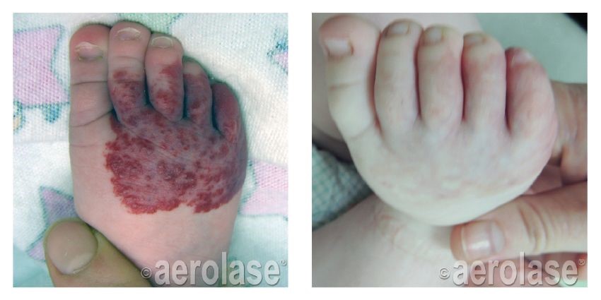 Vascular Lesion Treatment Florence SC