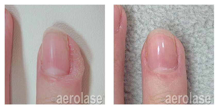 Wart Treatment Florence SC